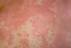 Hives Eczema And Other Rashes Allergy Asthma Specialists
